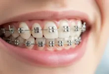 Expert Tips for Comfortable and Successful Teeth Straightening